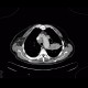 Lung carcinoma, carcinomatous lymphagiopathy: CT - Computed tomography